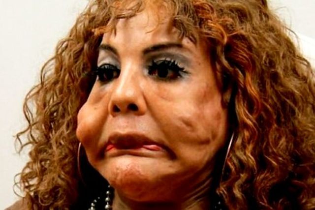 Injected with Cement: Her Unbelievable Transformation 14 Years Later ...